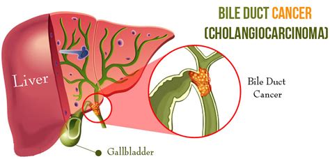 Liver and Bile Duct Cancer .